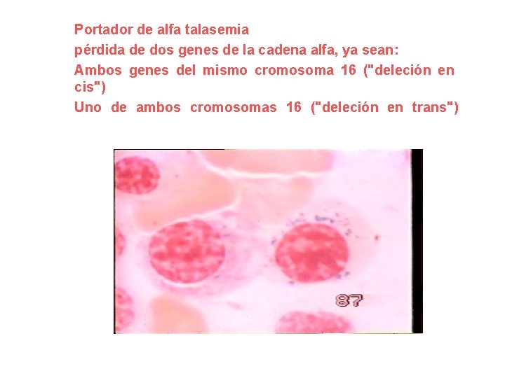 Portador de alfa talasemia pérdida de dos genes de la cadena alfa, ya sean: