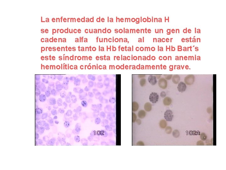 La enfermedad de la hemoglobina H se produce cuando solamente un gen de la