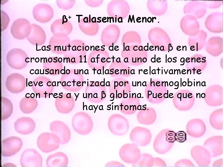 β+ Talasemia Menor. Las mutaciones de la cadena β en el cromosoma 11 afecta