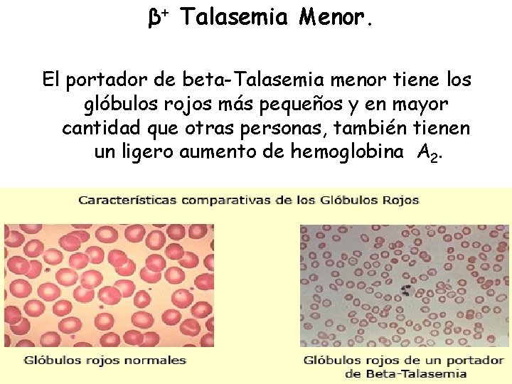 β+ Talasemia Menor. El portador de beta-Talasemia menor tiene los glóbulos rojos más pequeños