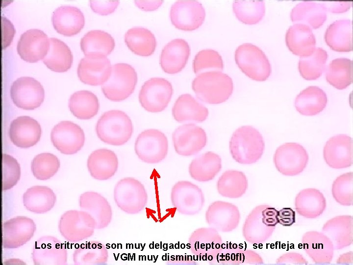 Los eritrocitos son muy delgados (leptocitos) se refleja en un VGM muy disminuído (±