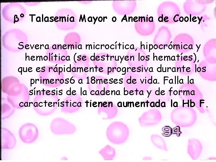 βº Talasemia Mayor o Anemia de Cooley. Severa anemia microcítica, hipocrómica y hemolítica (se