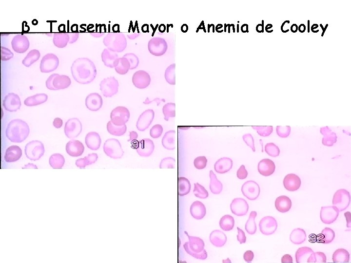 βº Talasemia Mayor o Anemia de Cooley 