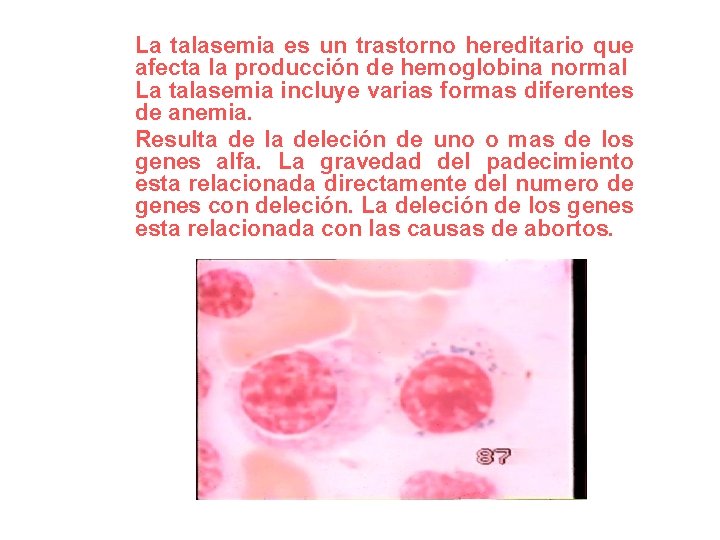La talasemia es un trastorno hereditario que afecta la producción de hemoglobina normal La