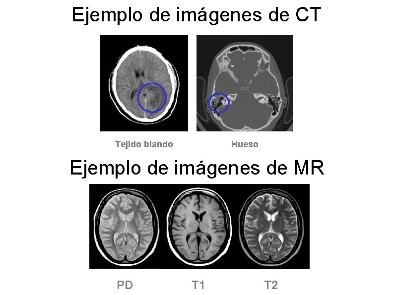 Ejemplo de imágenes de CT Tejido blando Hueso Ejemplo de imágenes de MR PD