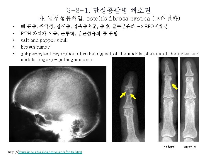 3 -2 -1. 만성콩팥병 뼈소견 마. 낭성섬유뼈염, osteitis fibrosa cystica (고뼈전환) • • •