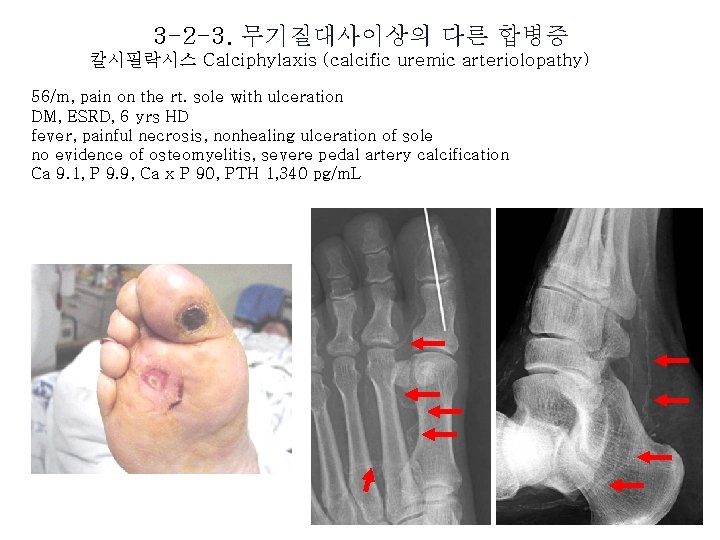 3 -2 -3. 무기질대사이상의 다른 합병증 칼시필락시스 Calciphylaxis (calcific uremic arteriolopathy) 56/m, pain on