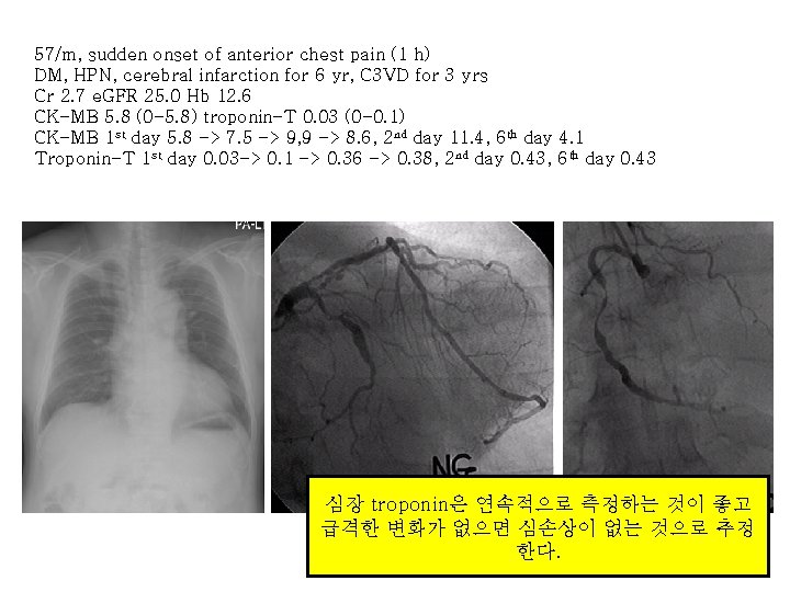 57/m, sudden onset of anterior chest pain (1 h) DM, HPN, cerebral infarction for