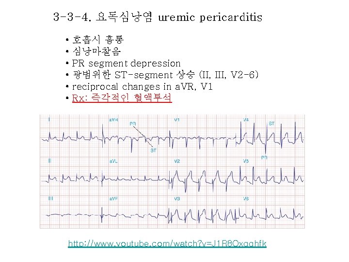 3 -3 -4. 요독심낭염 uremic pericarditis • • • 호흡시 흉통 심낭마찰음 PR segment