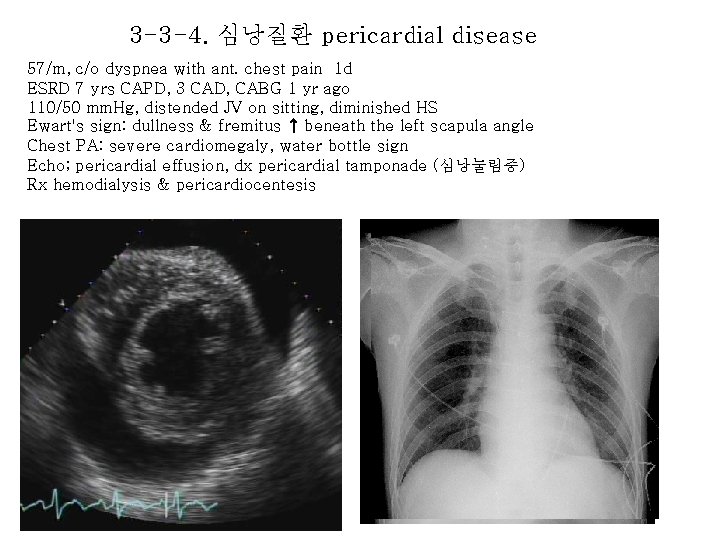 3 -3 -4. 심낭질환 pericardial disease 57/m, c/o dyspnea with ant. chest pain 1