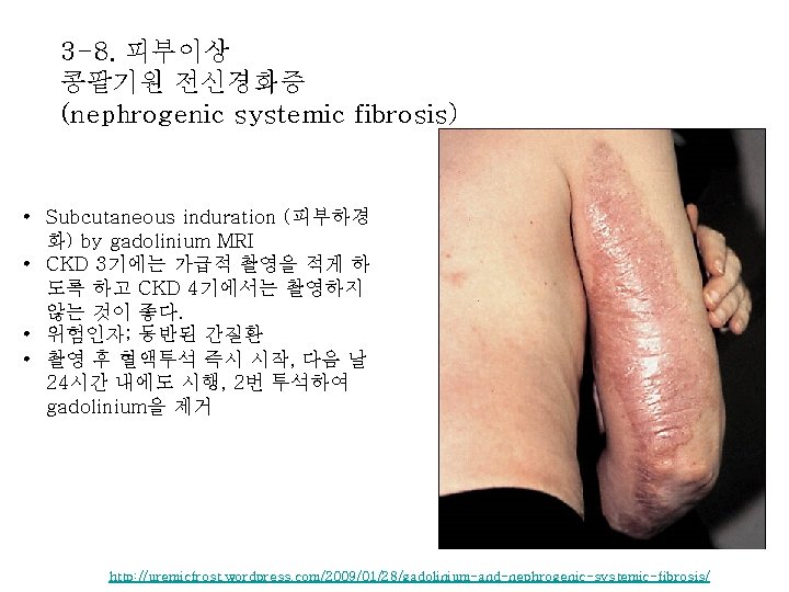 3 -8. 피부이상 콩팥기원 전신경화증 (nephrogenic systemic fibrosis) • Subcutaneous induration (피부하경 화) by