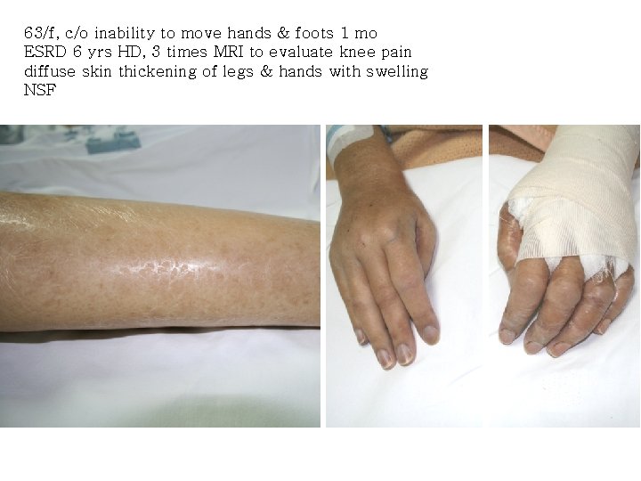 63/f, c/o inability to move hands & foots 1 mo ESRD 6 yrs HD,