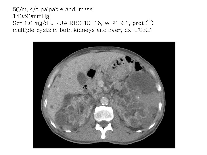 50/m, c/o palpable abd. mass 140/90 mm. Hg Scr 1. 0 mg/d. L, RUA