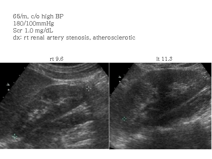 65/m, c/o high BP 180/100 mm. Hg Scr 1. 0 mg/d. L dx: rt