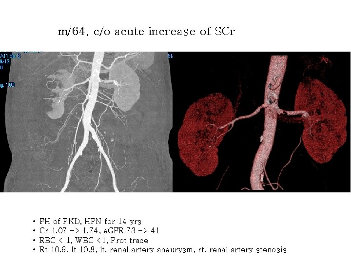 m/64, c/o acute increase of SCr • • FH of PKD, HPN for 14