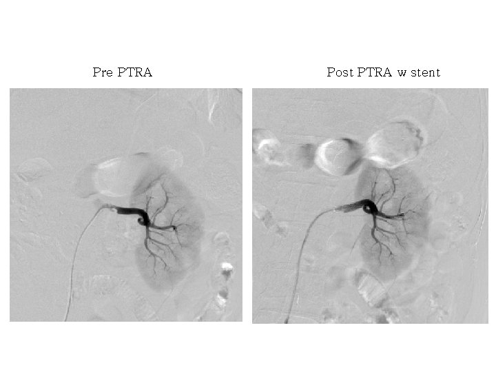 Pre PTRA Post PTRA w stent 