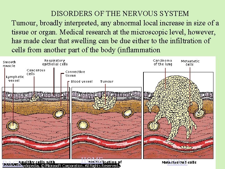 DISORDERS OF THE NERVOUS SYSTEM Tumour, broadly interpreted, any abnormal local increase in size