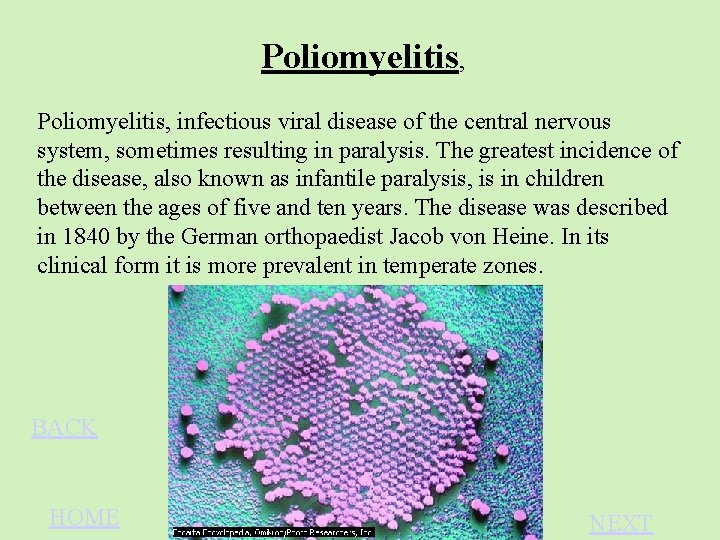 Poliomyelitis, infectious viral disease of the central nervous system, sometimes resulting in paralysis. The