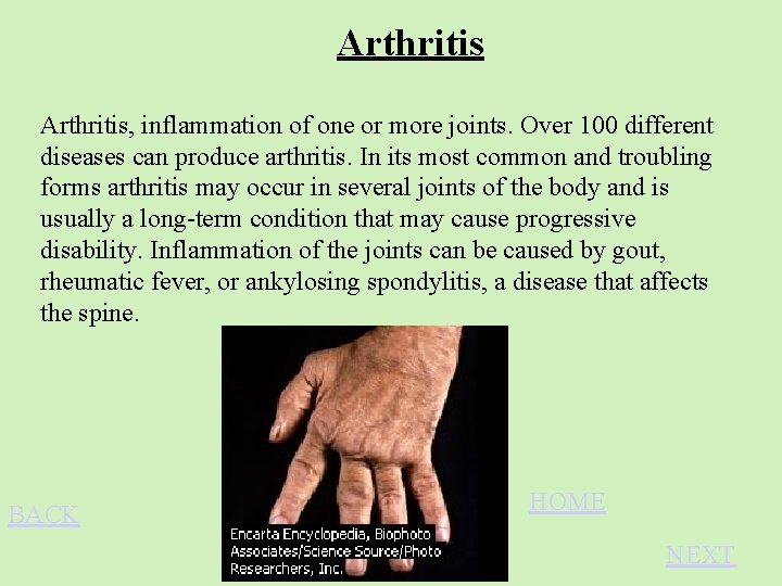 Arthritis, inflammation of one or more joints. Over 100 different diseases can produce arthritis.