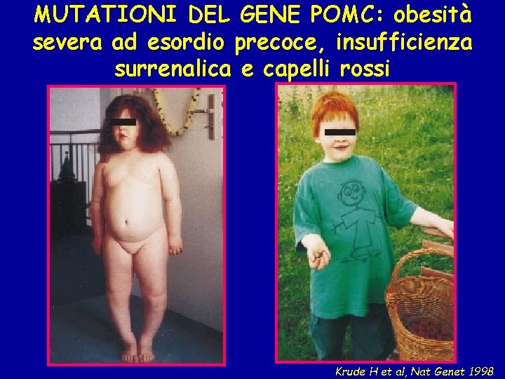 MUTATIONI DEL GENE POMC: obesità severa ad esordio precoce, insufficienza surrenalica e capelli rossi