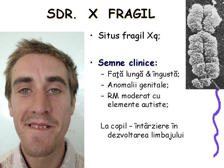 SDR. X FRAGIL • Situs fragil Xq; • Semne clinice: – Faţă lungă &