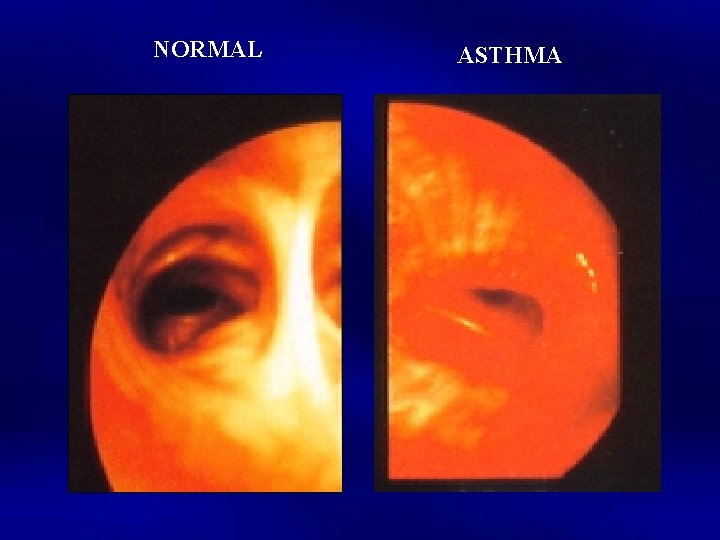 NORMAL ASTHMA 