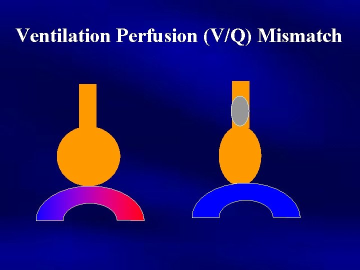 Ventilation Perfusion (V/Q) Mismatch 