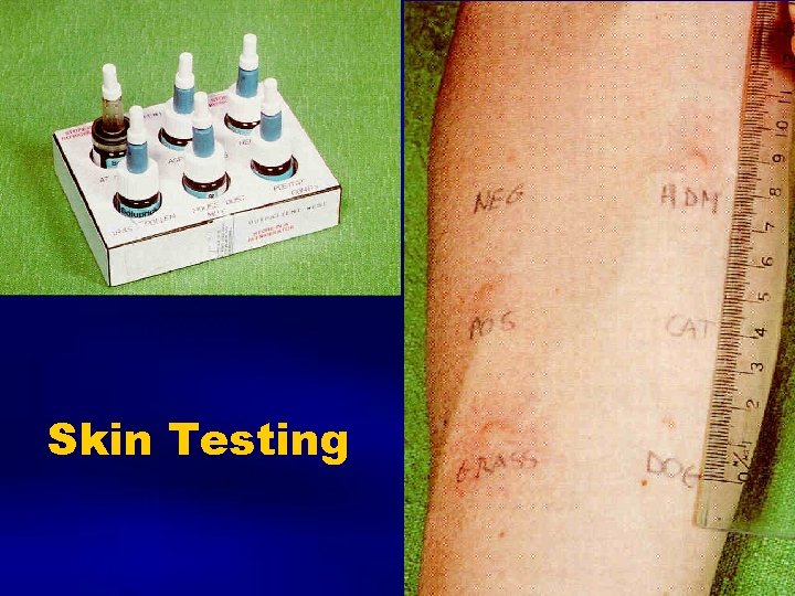 Skin Testing 