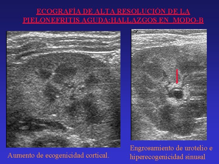 ECOGRAFÍA DE ALTA RESOLUCIÓN DE LA PIELONEFRITIS AGUDA: HALLAZGOS EN MODO-B Aumento de ecogenicidad