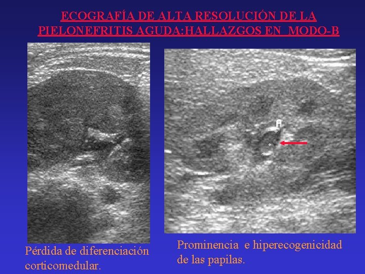 ECOGRAFÍA DE ALTA RESOLUCIÓN DE LA PIELONEFRITIS AGUDA: HALLAZGOS EN MODO-B Pérdida de diferenciación