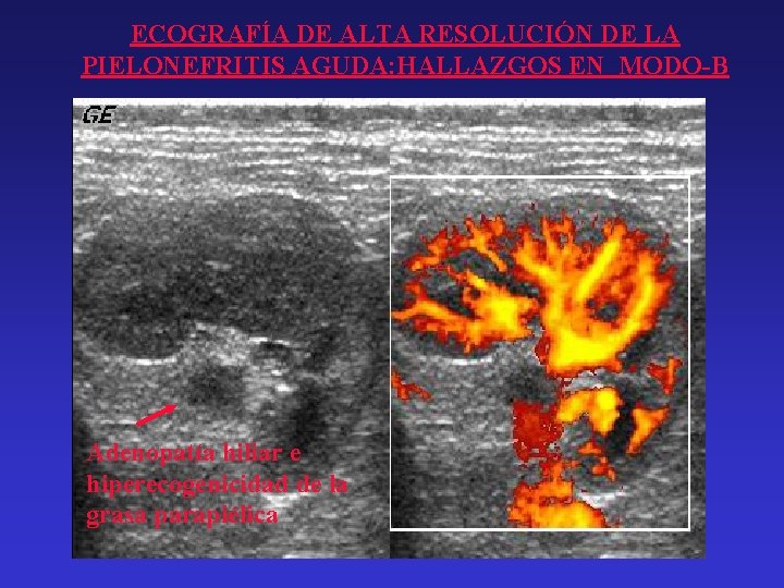 ECOGRAFÍA DE ALTA RESOLUCIÓN DE LA PIELONEFRITIS AGUDA: HALLAZGOS EN MODO-B Adenopatía hiliar e