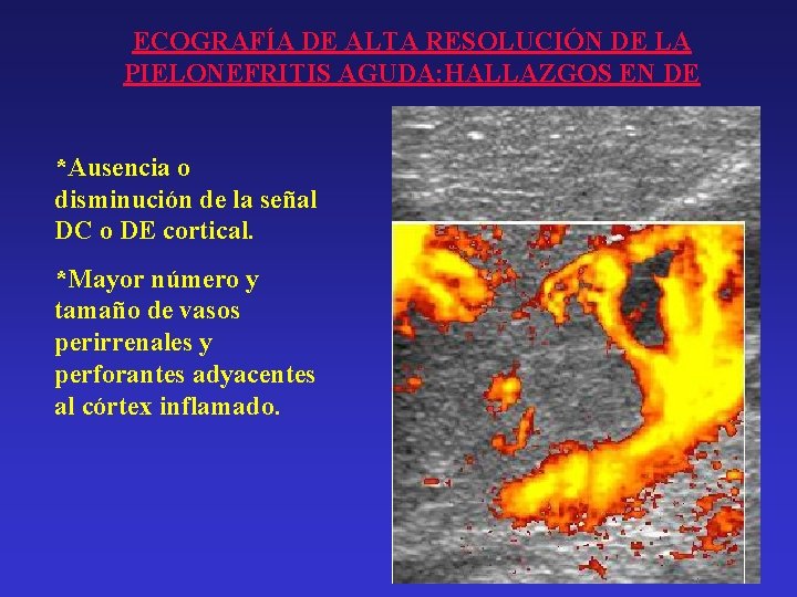ECOGRAFÍA DE ALTA RESOLUCIÓN DE LA PIELONEFRITIS AGUDA: HALLAZGOS EN DE *Ausencia o disminución