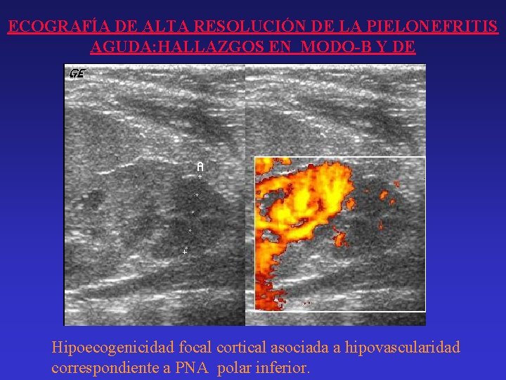 ECOGRAFÍA DE ALTA RESOLUCIÓN DE LA PIELONEFRITIS AGUDA: HALLAZGOS EN MODO-B Y DE Hipoecogenicidad