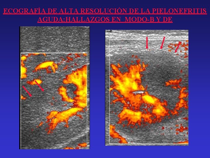 ECOGRAFÍA DE ALTA RESOLUCIÓN DE LA PIELONEFRITIS AGUDA: HALLAZGOS EN MODO-B Y DE 