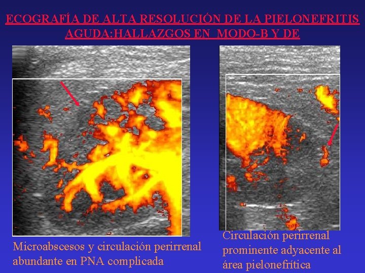 ECOGRAFÍA DE ALTA RESOLUCIÓN DE LA PIELONEFRITIS AGUDA: HALLAZGOS EN MODO-B Y DE Microabscesos