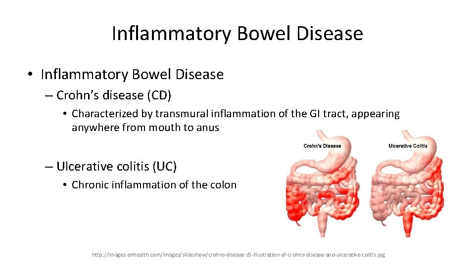 Inflammatory Bowel Disease • Inflammatory Bowel Disease – Crohn’s disease (CD) • Characterized by