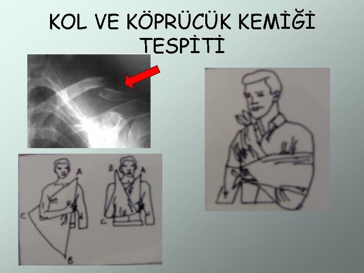 KOL VE KÖPRÜCÜK KEMİĞİ TESPİTİ 