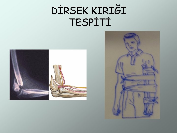 DİRSEK KIRIĞI TESPİTİ 