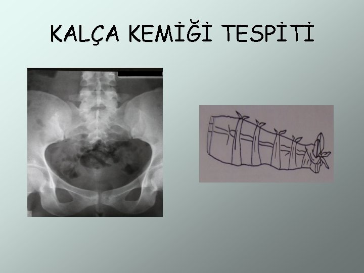 KALÇA KEMİĞİ TESPİTİ 