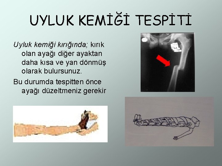 UYLUK KEMİĞİ TESPİTİ Uyluk kemiği kırığında; kırık olan ayağı diğer ayaktan daha kısa ve