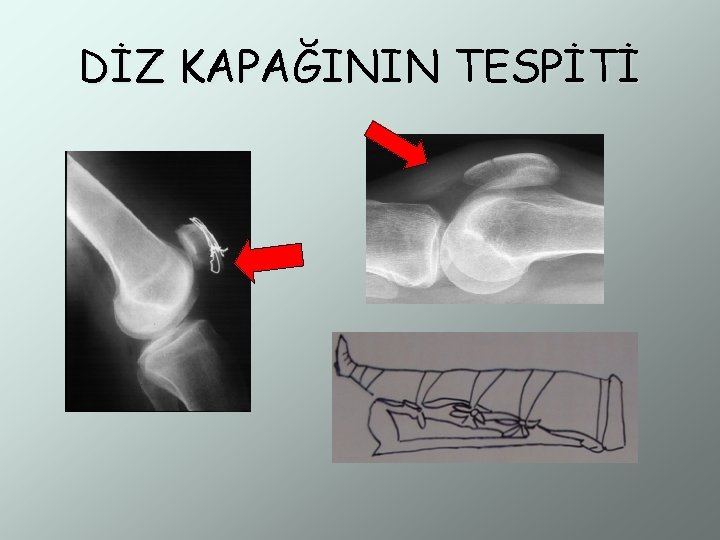 DİZ KAPAĞININ TESPİTİ 