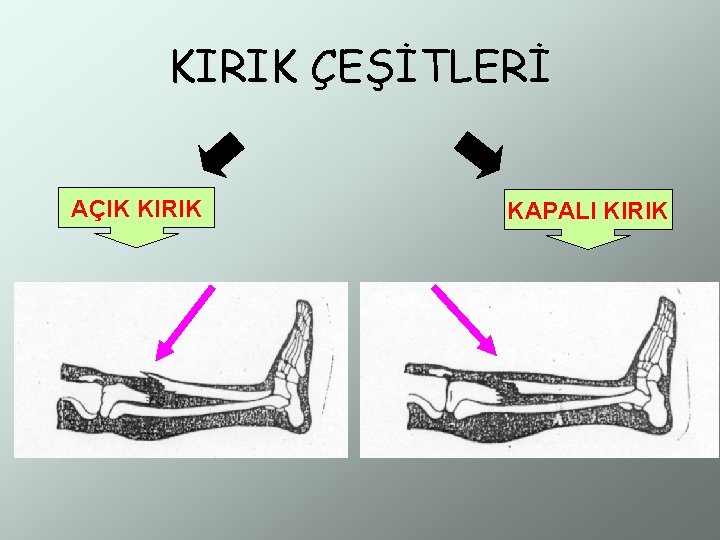 KIRIK ÇEŞİTLERİ AÇIK KIRIK KAPALI KIRIK 