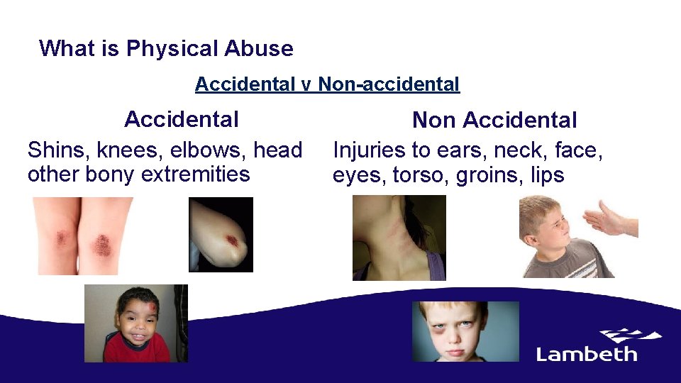 What is Physical Abuse Accidental v Non-accidental Accidental Shins, knees, elbows, head other bony