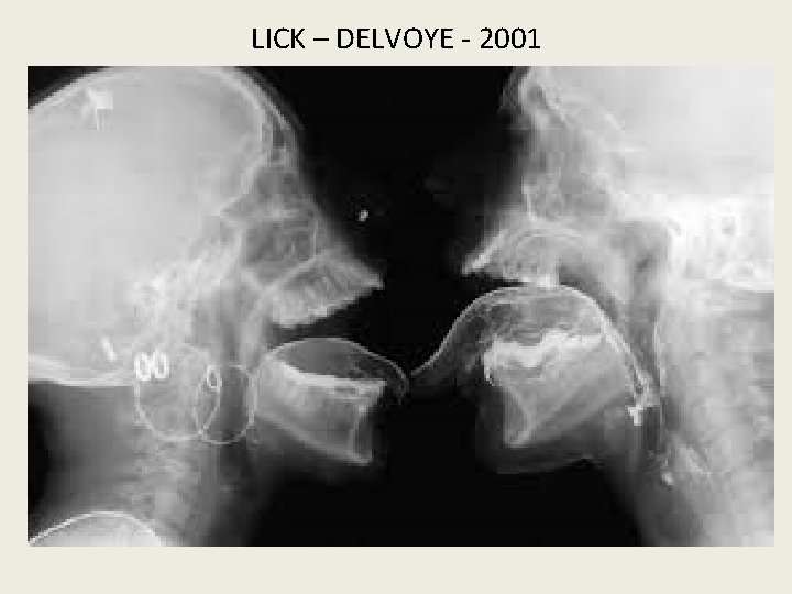 LICK – DELVOYE - 2001 