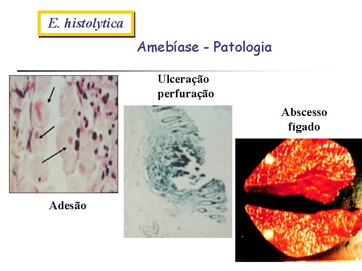E. histolytica Amebíase - Patologia Ulceração perfuração Abscesso fígado Adesão 