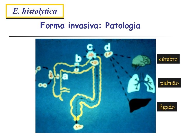E. histolytica Amebíase Forma invasiva: Forma Patologia extra-intestinal cérebro pulmão fígado 