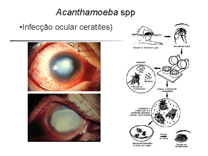 Acanthamoeba spp • Infecção ocular ceratites) 