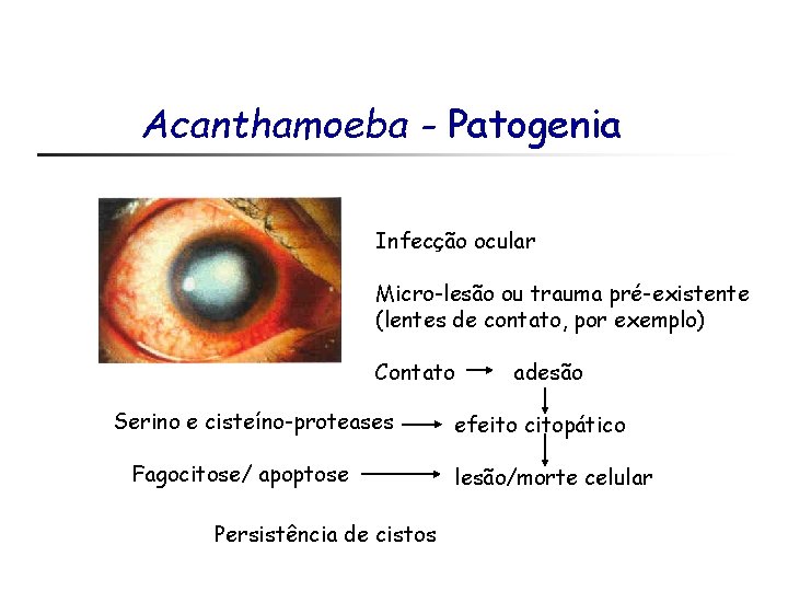 Acanthamoeba - Patogenia Infecção ocular Micro-lesão ou trauma pré-existente (lentes de contato, por exemplo)