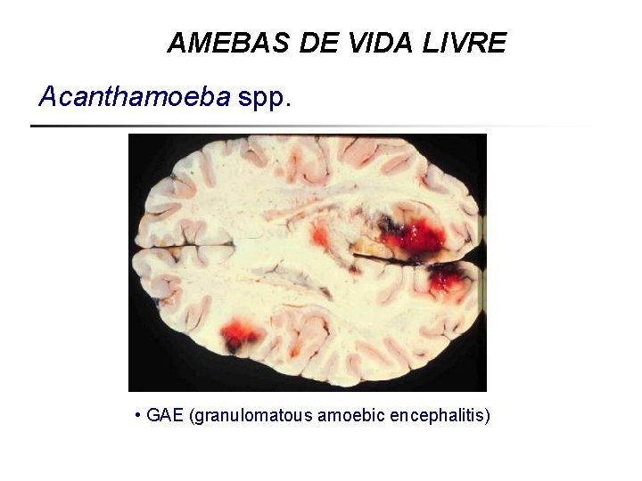 AMEBAS DE VIDA LIVRE Acanthamoeba spp. • GAE (granulomatous amoebic encephalitis) 