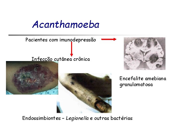 Acanthamoeba Pacientes com imunodepressão Infecção cutânea crônica Encefalite amebiana granulomatosa Endossimbiontes – Legionella e